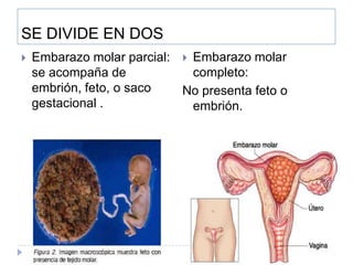 SE DIVIDE EN DOS
 Embarazo molar parcial:
se acompaña de
embrión, feto, o saco
gestacional .
 Embarazo molar
completo:
No presenta feto o
embrión.
 