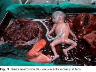 Mola hidatiforme & coriocarcinoma