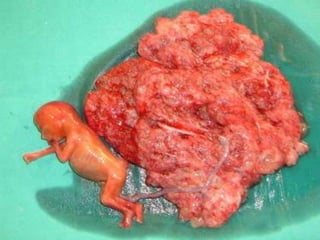 Mola hidatiforme & coriocarcinoma