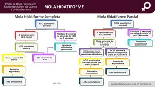 portaldeboaspraticas.iff.fiocruz.br
MOLA HIDATIFORME
Mola Hidatiforme Completa
MS, 2021.
Mola Hidatiforme Parcial
 