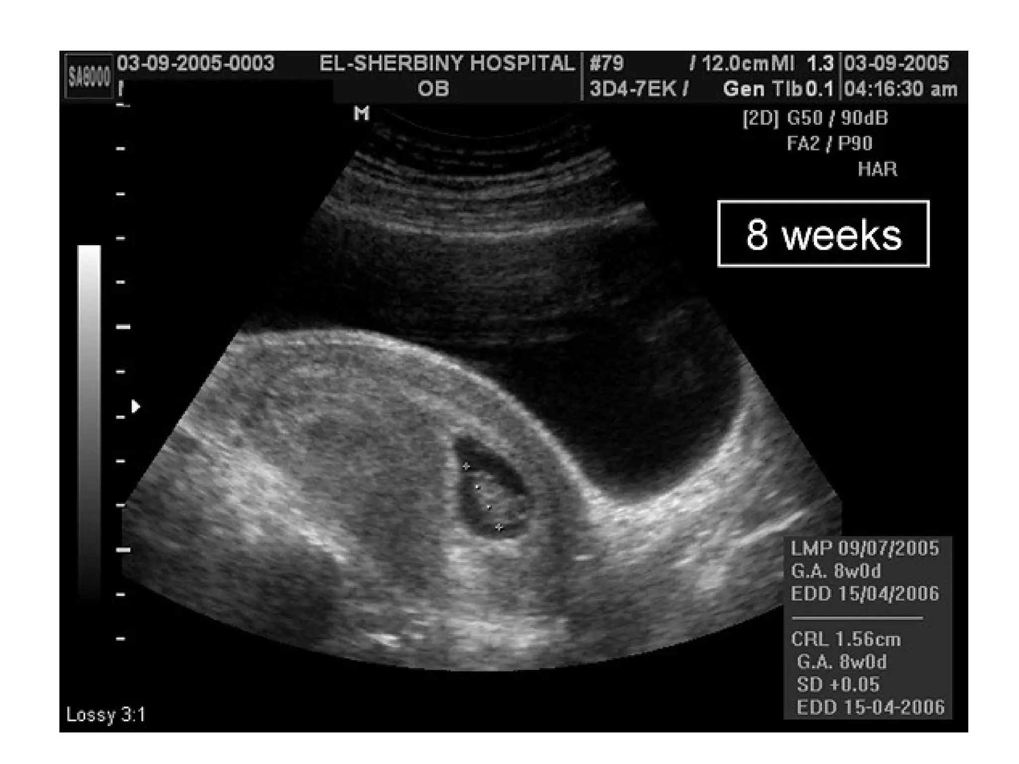 Molar pregnancy | PPT