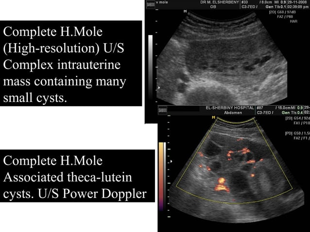 Molar pregnancy