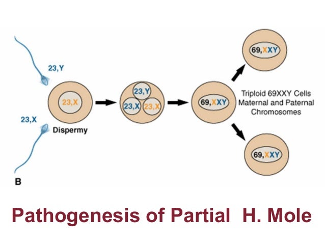 Molar pregnancy