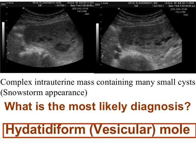  What Would One Expect To See At  Scan If Her Pregnancy Is Normal?                    Gestational (Chorionic) Sac 