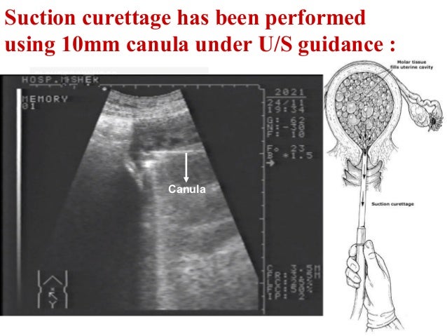 Meticulous histopathological examination revealed:Villi have extensive stromal edemaAbnormal trophoblastic proliferation...