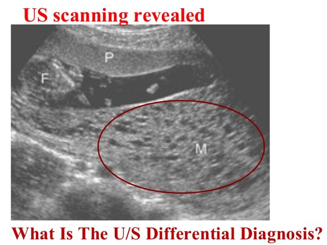 β hCG :80,000 mµ/ml  Free T4 : 2µg/ml (N 0.3-1.7µg/ml)  Protein in urine: Negative U/S Tertiary center report:Molar pregna...