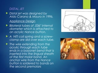 Distalisation Jet Molar distalisation | PPT