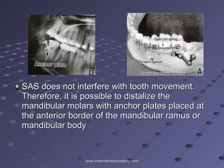 SAS does not interfere with tooth movement.SAS does not interfere with tooth movement.
Therefore, it is possible to distalize theTherefore, it is possible to distalize the
mandibular molars with anchor plates placed atmandibular molars with anchor plates placed at
the anterior border of the mandibular ramus orthe anterior border of the mandibular ramus or
mandibular bodymandibular body
www.indiandentalacademy.comwww.indiandentalacademy.com
 