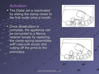 Activation:Activation:
The Distal Jet is reactivatedThe Distal Jet is reactivated
by sliding the clamp closer toby sliding the clamp closer to
the first molar once a month.the first molar once a month.
Once distalization isOnce distalization is
complete, the appliance cancomplete, the appliance can
be converted to a Nancebe converted to a Nance
retainer simply by replacingretainer simply by replacing
the clamp-spring assembliesthe clamp-spring assemblies
with cold-cure acrylic andwith cold-cure acrylic and
cutting off the arms to thecutting off the arms to the
premolarspremolars..
www.indiandentalacademy.comwww.indiandentalacademy.com
 