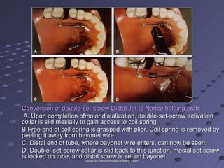 Conversion of double-set-screw Distal Jet to Nance holding arch:Conversion of double-set-screw Distal Jet to Nance holding arch:
A. Upon completion ofmolar distalization, double-set-screw activationA. Upon completion ofmolar distalization, double-set-screw activation
collar is slid mesially to gain access to coil spring.collar is slid mesially to gain access to coil spring.
B.Free end of coil spring is grasped with plier. Coil spring is removed byB.Free end of coil spring is grasped with plier. Coil spring is removed by
peeling it away from bayonet wire.peeling it away from bayonet wire.
C. Distal end of tube, where bayonet wire enters, can now be seen.C. Distal end of tube, where bayonet wire enters, can now be seen.
D. Double set-screw collar is slid back to this junction, mesial set screwD. Double set-screw collar is slid back to this junction, mesial set screw
is locked on tube, and distal screw is set on bayonet.is locked on tube, and distal screw is set on bayonet.
www.indiandentalacademy.comwww.indiandentalacademy.com
 