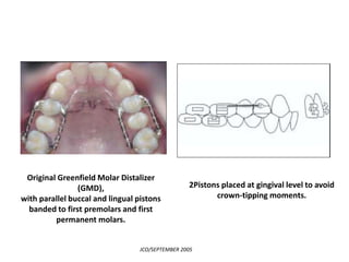 Molar distalization | PPT
