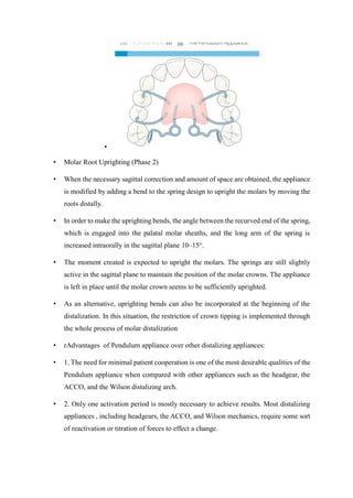 MOLAR DISTALIZATION , headgear, fixed functional | PDF