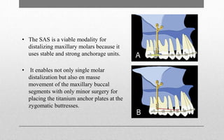 Molar distalisation in Orthodontics | PPTX