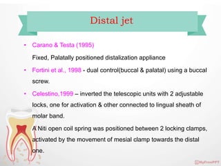 Distalisation Jet Molar distalization | PPTX