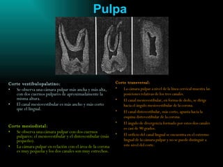 Pulpa Corte vestibulopalatino: Se observa una cámara pulpar más ancha y más alta, con dos cuernos pulpares de aproximadamente la misma altura. El canal mesiovestibular es más ancho y más corto que el lingual. Corte mesiodistal: Se observa una cámara pulpar con dos cuernos pulpares: el mesiovestibular y el distovestibular (más pequeño). La cámara pulpar en relación con el área de la corona es muy pequeña y los dos canales son muy estrechos. Corte transversal: La cámara pulpar a nivel de la línea cervical muestra las posiciones relativas de los tres canales. El canal mesiovestibular, en forma de dedo, se dirige hacia el ángulo mesiovestibular de la corona. El canal distovestibular, más corto, apunta hacia la esquina distovestibular de la corona. El ángulo de divergencia formado por estos dos canales es casi de 90 grados. El orificio del canal lingual se encuentra en el extremo lingual de la cámara pulpar y no se puede distinguir a este nivel del corte.   