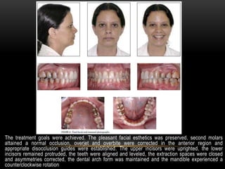 Molar extractions in orthodontics | PPTX