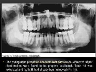 Molar extractions in orthodontics | PPTX