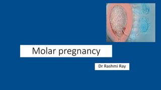 Molar pregnancy
Dr Rashmi Ray
 