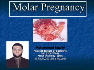   Molar Pregnancy Mohammed khairy Assisted lecture of obstetric and gynecology Assiut university- Egypt [email_address] 