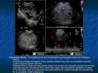 Complete Mole.Complete Mole. Transabdominal and transvaginal sonographs show an enlargedTransabdominal and transvaginal sonographs show an enlarged
uterusuterus
containing a large echogenic mass (yellow dotted line) with innumerable anechoiccontaining a large echogenic mass (yellow dotted line) with innumerable anechoic
(cystic) spaces (green arrows).  (cystic) spaces (green arrows).  
Vascular flow is seen during systole (open red arrow) and diastole (closed red arrow),Vascular flow is seen during systole (open red arrow) and diastole (closed red arrow),
representing low resistance flow within this mass. No intrauterine gestation is seen.representing low resistance flow within this mass. No intrauterine gestation is seen.
In combination with an extremely elevated beta-hCG, these findings are concerningIn combination with an extremely elevated beta-hCG, these findings are concerning
for a complete molar pregnancy.for a complete molar pregnancy.
 