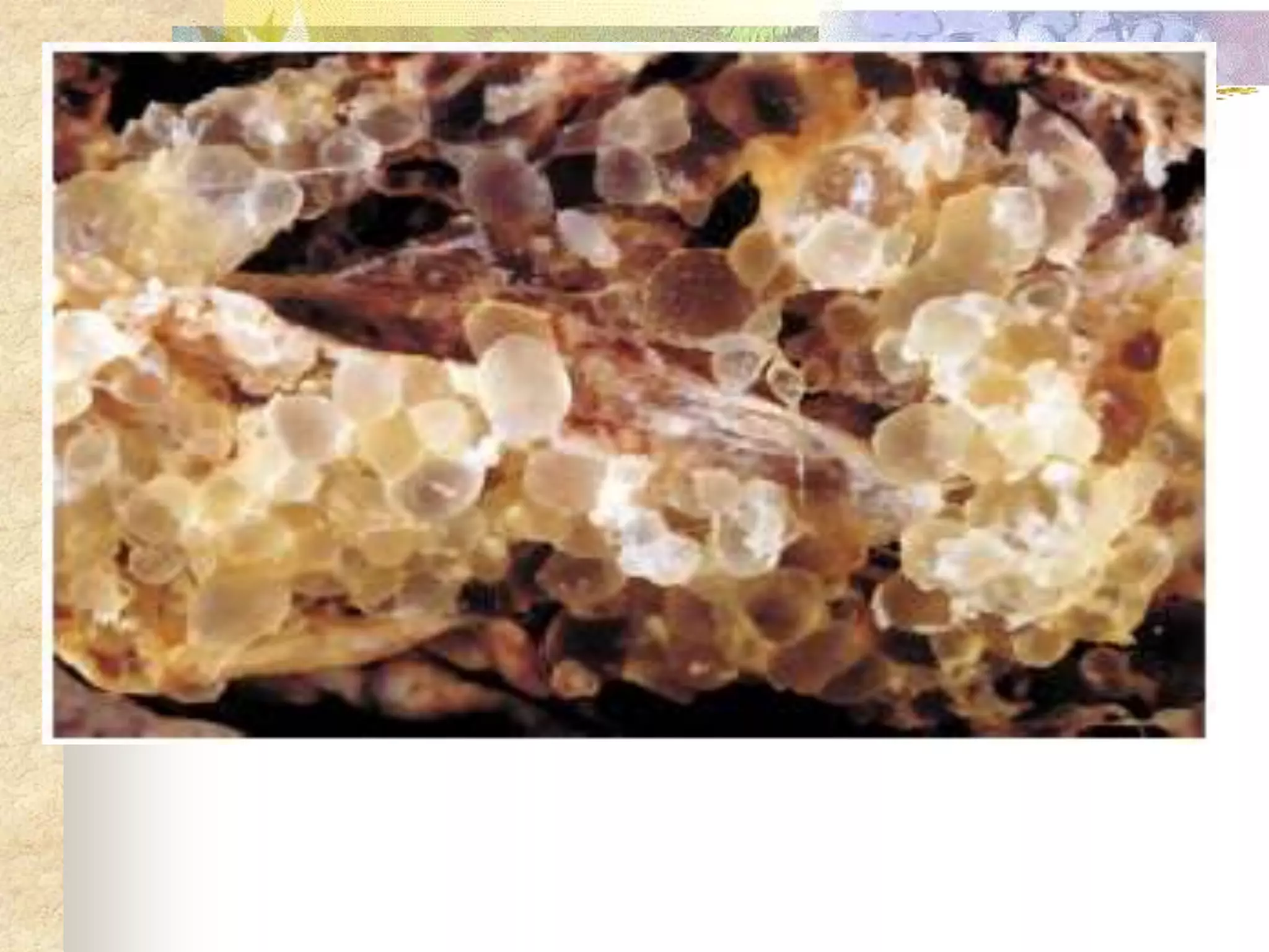 Molar pregnancy | PPT