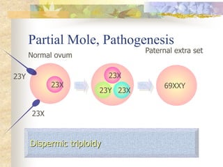 Partial Mole, Pathogenesis
69XXY
Normal ovum
23X
Dispermic triploidy
Paternal extra set
23Y 23X
23Y 23X
23X
 