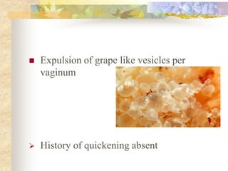  Expulsion of grape like vesicles per
vaginum
 History of quickening absent
 
