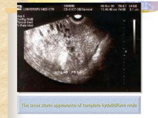 The snow storm appearance of complete hydatidiform mole
 