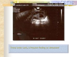 Theca lutein cysts, a frequent finding on ultrasound
 