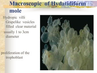 Macroscopic of Hydatidiform
mole
Hydropic villi
Grapelike vesicles
filled clear material
usually 1 to 3cm
diameter
proliferation of the
trophoblast
 