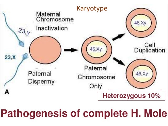 Molar pregnancy