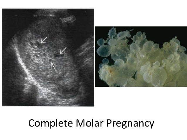 Molar pregnancy
