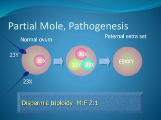 Partial Mole, Pathogenesis
69XXY
Normal ovum
23X
Dispermic triploidy M:F 2:1
Paternal extra set
23Y 23X
23Y 23X
23X
 