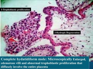 1-Trophoblastic proliferation
2-Hydropic Degeneration
Complete hydatidiform mole: Microscopically Enlarged,
edematous villi and abnormal trophoblastic proliferation that
diffusely involve the entire placenta
 