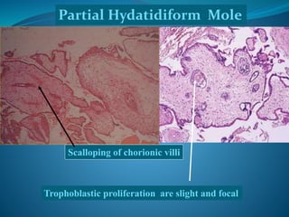 Scalloping of chorionic villi
Partial Hydatidiform Mole
Trophoblastic proliferation are slight and focal
 