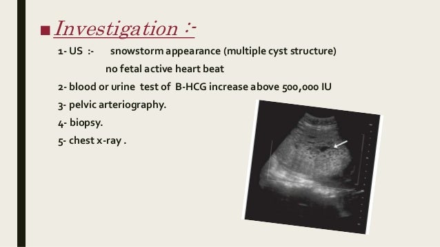 Molar pregnancy from a-z