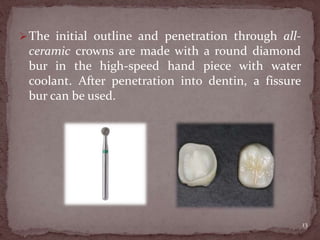 The initial outline and penetration through all-
ceramic crowns are made with a round diamond
bur in the high-speed hand piece with water
coolant. After penetration into dentin, a fissure
bur can be used.
13
 