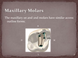 The maxillary 1st and 2nd molars have similar access
outline forms.
15
MB1
DB
L
MB2
B
L
MD
 