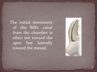 The initial movement
of the MB2 canal
from the chamber is
often not toward the
apex but laterally
toward the mesial.
16
 