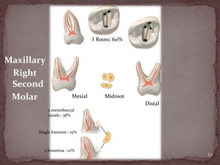 23
3 Roots: 60%
2 mesiobuccal
canals : 38%
Mesial Midroot
Distal
Single foramen : 15%
2 foramina : 10%
Maxillary
Right
Second
Molar
 