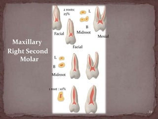24
2 roots:
25%
L
B
Maxillary
Right Second
Molar
Facial
Facial
Mesial
Midroot
Midroot
L
B
1 root : 10%
 