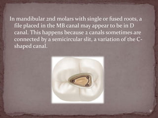 In mandibular 2nd molars with single or fused roots, a
file placed in the MB canal may appear to be in D
canal. This happens because 2 canals sometimes are
connected by a semicircular slit, a variation of the C-
shaped canal.
31
 