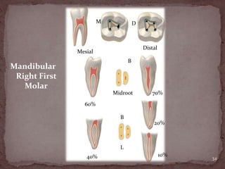 34
Mandibular
Right First
Molar
M D
Mesial
60%
B
Midroot
Distal
70%
40%
20%
10%
B
L
 