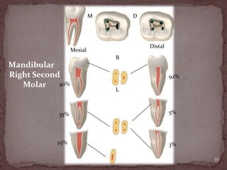35
Mandibular
Right Second
Molar
M D
Mesial
40%
B
L
Distal
92%
5%35%
25% 3%
 
