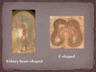 Kidney bean–shaped
C-shaped
7
 