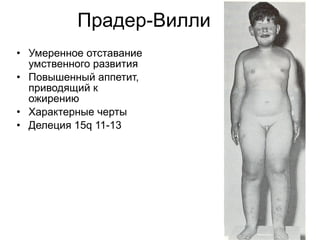 Прадер-Вилли Умеренное отставание умственного развития Повышенный аппетит, приводящий к ожирению Характерные черты  Делеция  15q 11-13  