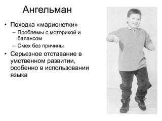Ангельман Походка «марионетки» Проблемы с моторикой и балансом Смех без причины Серьезное отставание в умственном развитии, особенно в использовании языка 