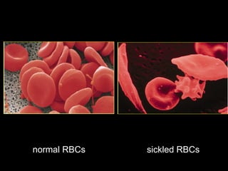 normal RBCs   sickled RBCs
 