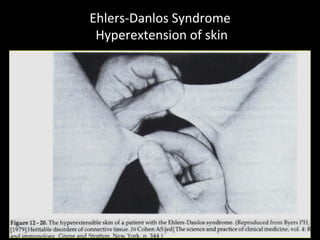 Ehlers-­‐Danlos	
  Syndrome	
  
	
  Hyperextension	
  of	
  skin	
  
 