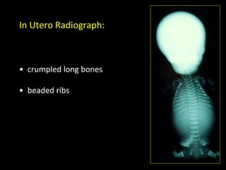In	
  Utero	
  Radiograph:	
  



• 	
  	
  crumpled	
  long	
  bones	
  

• 	
  	
  beaded	
  ribs	
  
 
